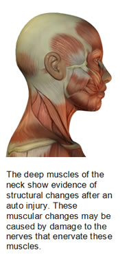 3D deep muscles illustration showing structural changes in the neck after an auto injury